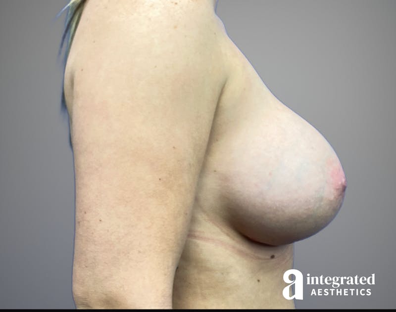 Breast Augmentation Before & After Gallery - Patient 232509 - Image 6