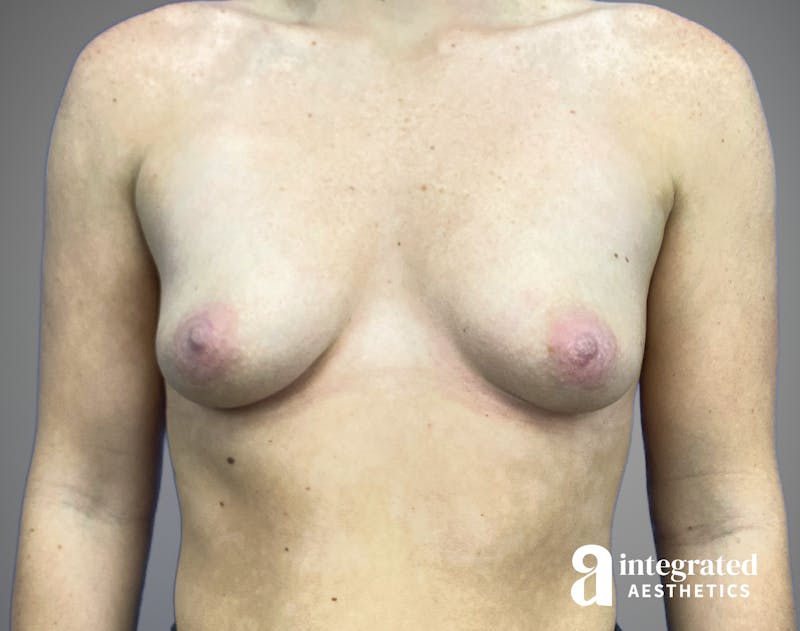 Breast Augmentation Before & After Gallery - Patient 232509 - Image 1