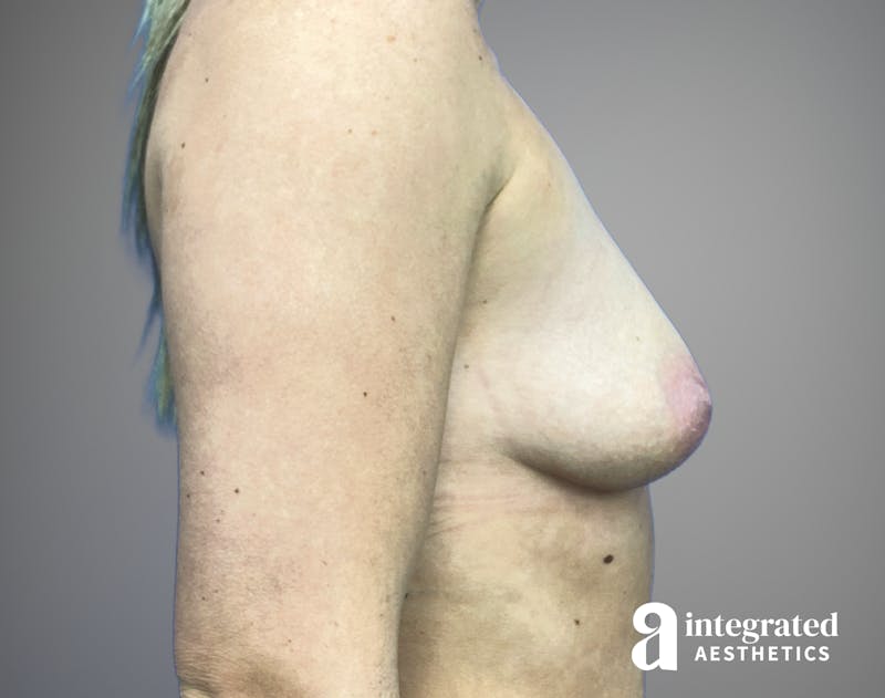 Breast Augmentation Before & After Gallery - Patient 232509 - Image 5