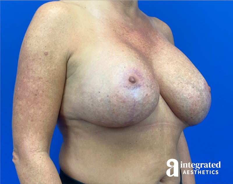 Breast Augmentation Before & After Gallery - Patient 281419 - Image 4