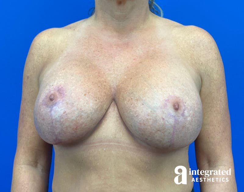 Breast Augmentation Before & After Gallery - Patient 281419 - Image 2