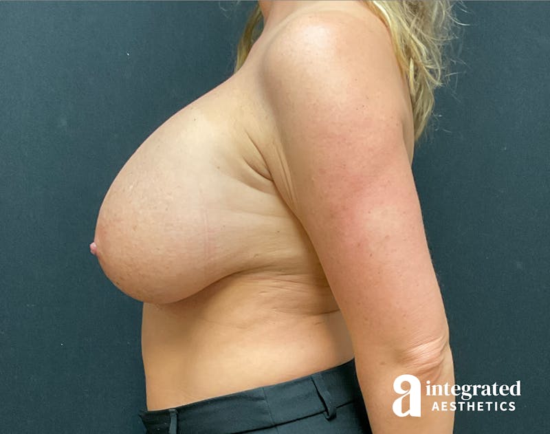 Breast Augmentation Before & After Gallery - Patient 281419 - Image 9