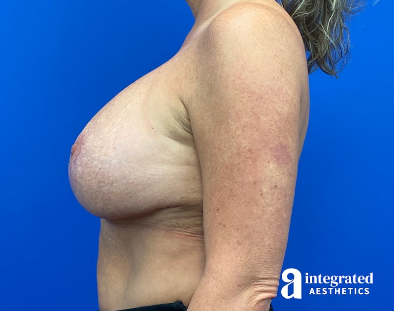 Breast Augmentation Before & After Gallery - Patient 281419 - Image 10