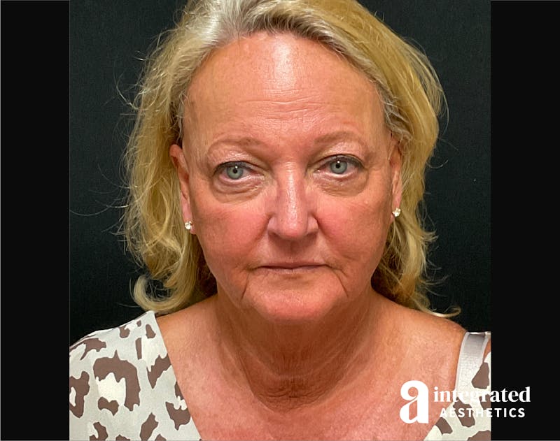 Facelift & Neck Lift Before & After Gallery - Patient 194392 - Image 1
