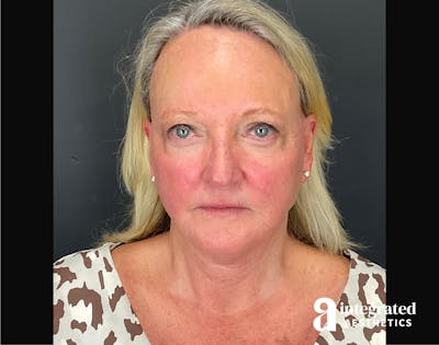 Facelift & Neck Lift Before & After Gallery - Patient 194392 - Image 2