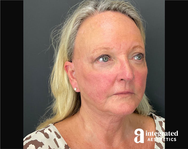 Facelift & Neck Lift Before & After Gallery - Patient 194392 - Image 4