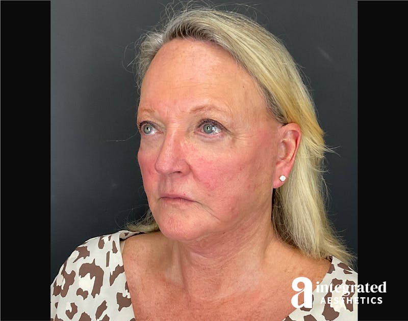 Facelift & Neck Lift Before & After Gallery - Patient 194392 - Image 6