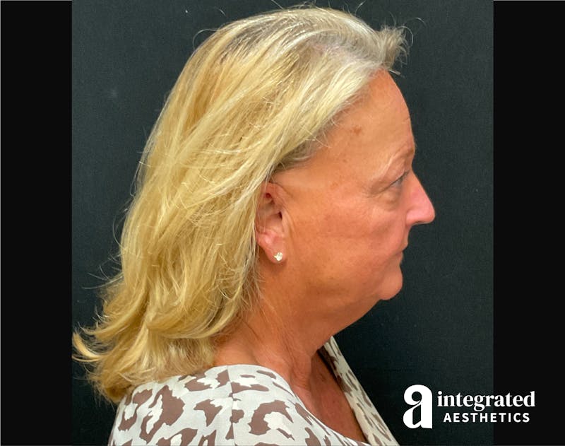 Facelift & Neck Lift Before & After Gallery - Patient 194392 - Image 7