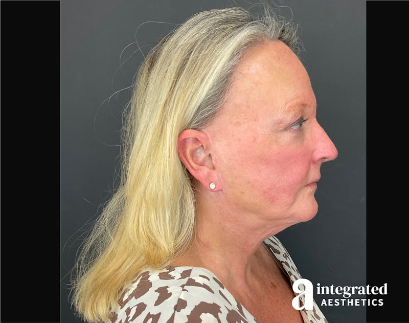 Facelift & Neck Lift Before & After Gallery - Patient 194392 - Image 8