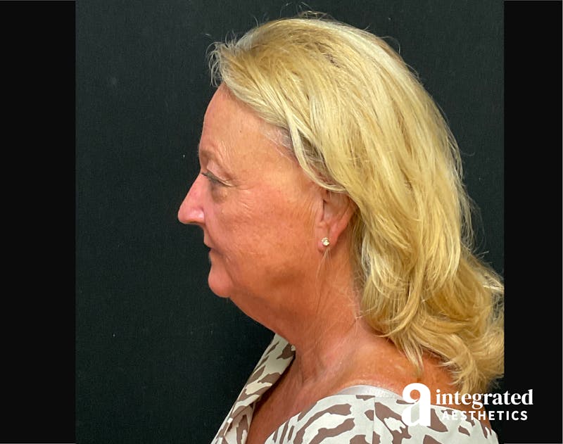 Facelift & Neck Lift Before & After Gallery - Patient 194392 - Image 9