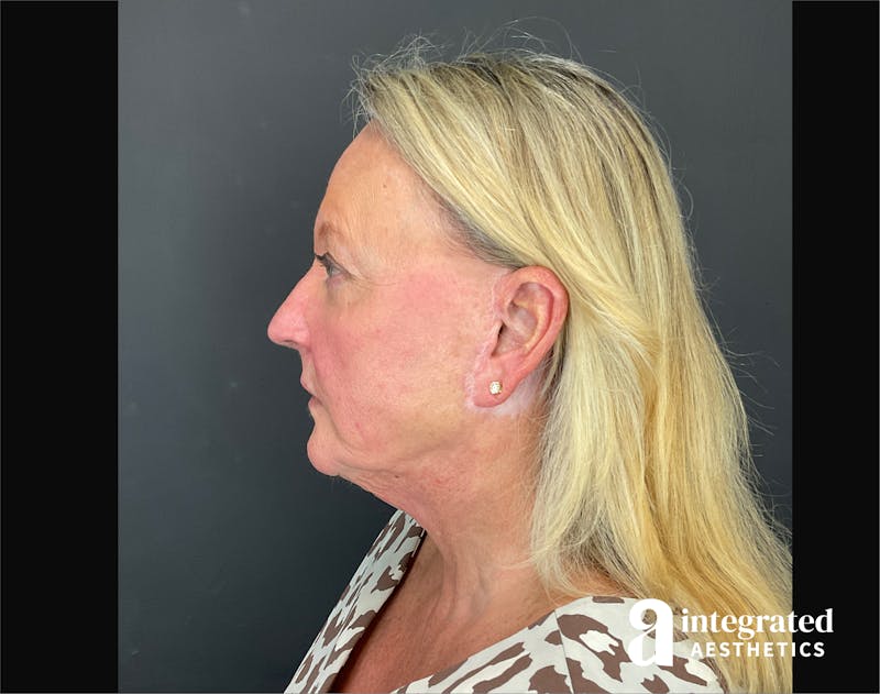 Facelift & Neck Lift Before & After Gallery - Patient 194392 - Image 10