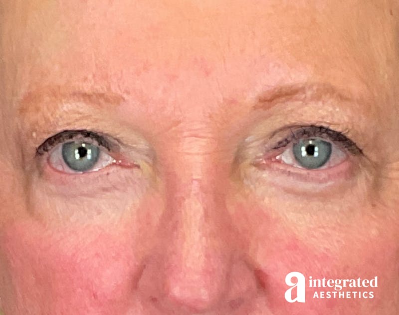 Blepharoplasty Before & After Gallery - Patient 218491 - Image 2