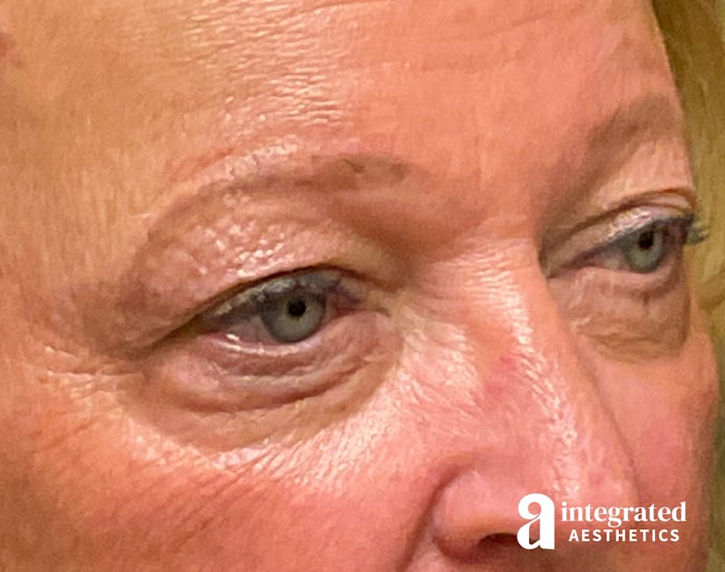 Blepharoplasty Before & After Gallery - Patient 218491 - Image 3