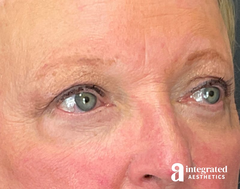 Blepharoplasty Before & After Gallery - Patient 218491 - Image 4