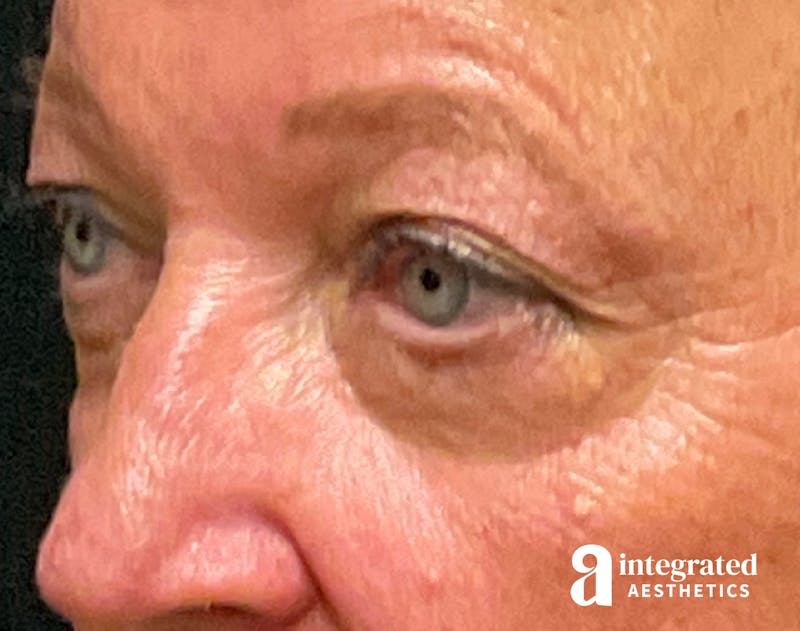 Blepharoplasty Before & After Gallery - Patient 218491 - Image 5
