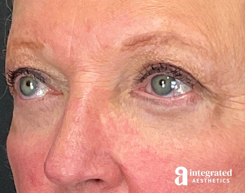 Blepharoplasty Before & After Gallery - Patient 218491 - Image 6