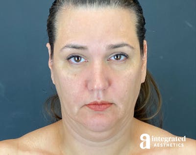 Facelift & Neck Lift Before & After Gallery - Patient 614844 - Image 1