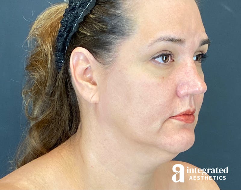 Facelift & Neck Lift Before & After Gallery - Patient 614844 - Image 3