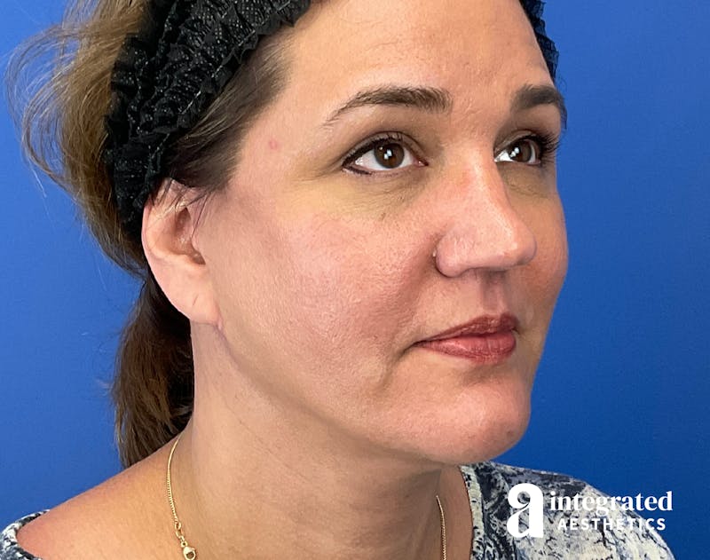 Facelift & Neck Lift Before & After Gallery - Patient 614844 - Image 4