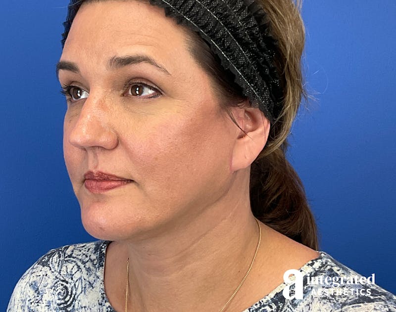Facelift & Neck Lift Before & After Gallery - Patient 614844 - Image 6