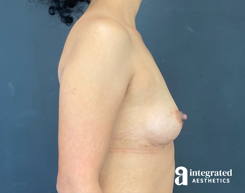 Breast Augmentation Before & After Gallery - Patient 201305 - Image 5