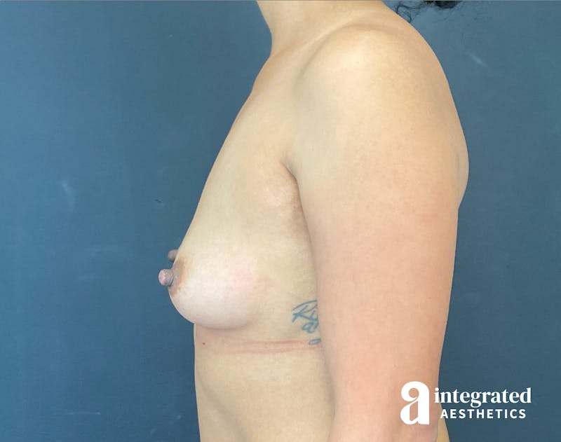 Breast Augmentation Before & After Gallery - Patient 201305 - Image 9