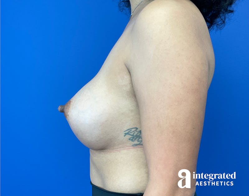 Breast Augmentation Before & After Gallery - Patient 201305 - Image 10