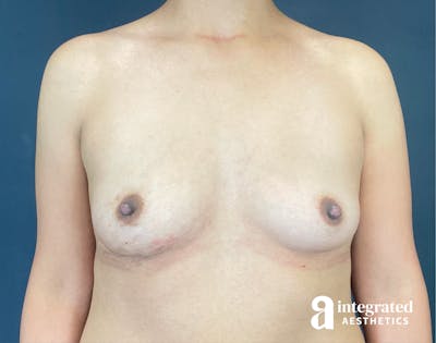 Breast Augmentation Before & After Gallery - Patient 201305 - Image 1