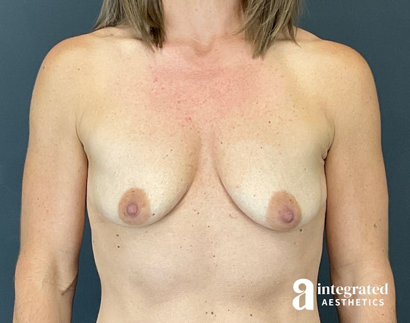 Breast Augmentation Before & After Gallery - Patient 395866 - Image 1