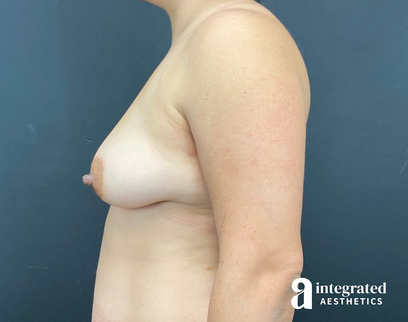 Breast Augmentation Before & After Gallery - Patient 230649 - Image 9