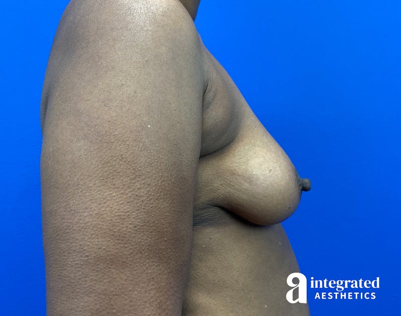 Breast Augmentation Before & After Gallery - Patient 133929 - Image 5