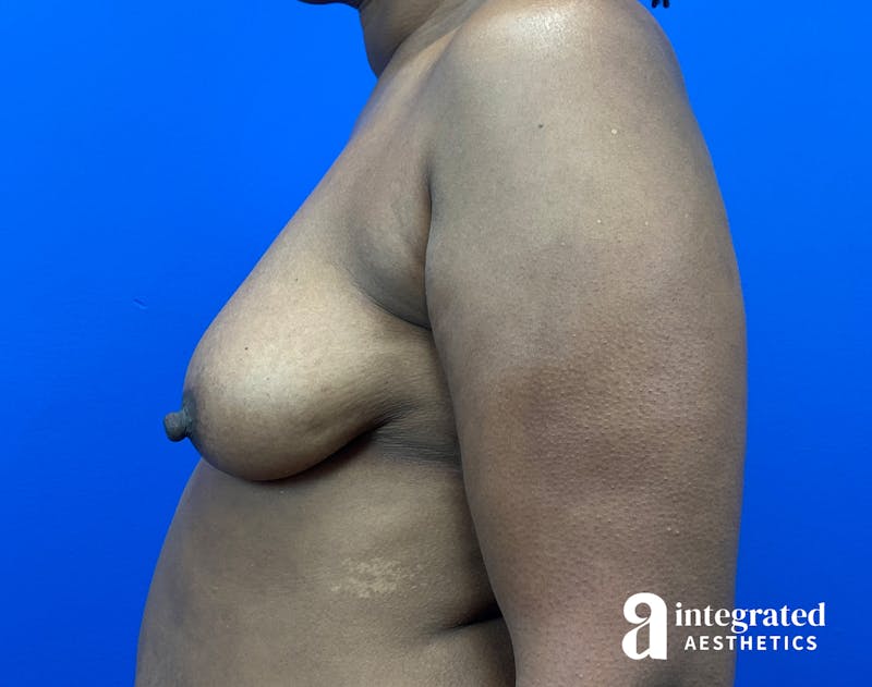 Breast Augmentation Before & After Gallery - Patient 133929 - Image 9