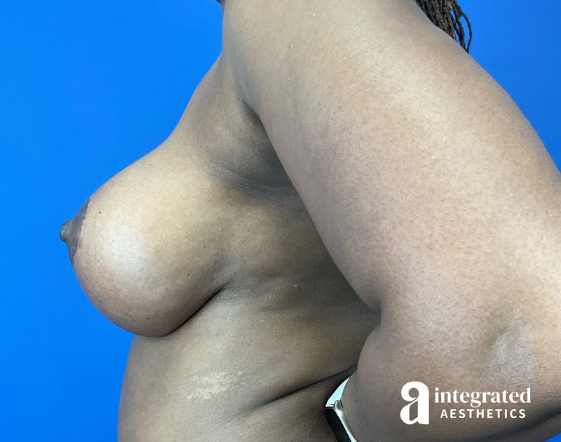 Breast Augmentation Before & After Gallery - Patient 133929 - Image 10