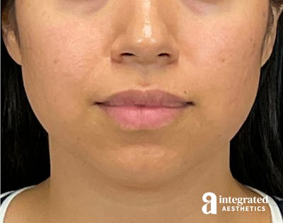 FaceTite & AccuTite Before & After Gallery - Patient 207863 - Image 1