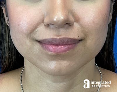 FaceTite & AccuTite Before & After Gallery - Patient 207863 - Image 2