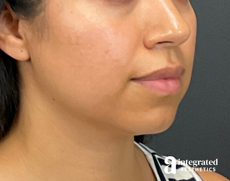 FaceTite & AccuTite Before & After Gallery - Patient 207863 - Image 3