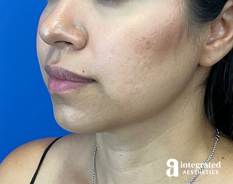 FaceTite & AccuTite Before & After Gallery - Patient 207863 - Image 6