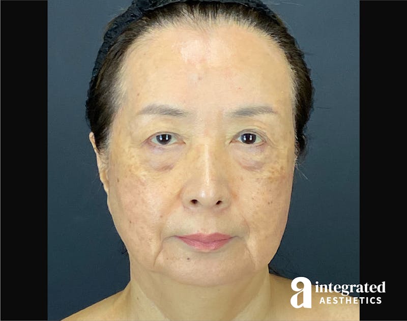 Facelift & Neck Lift Before & After Gallery - Patient 423746 - Image 1