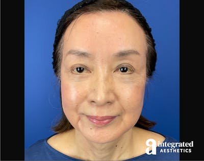 Facelift & Neck Lift Before & After Gallery - Patient 423746 - Image 2