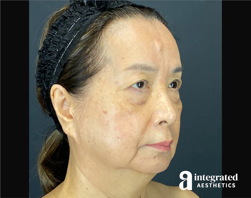 Facelift & Neck Lift Before & After Gallery - Patient 423746 - Image 3