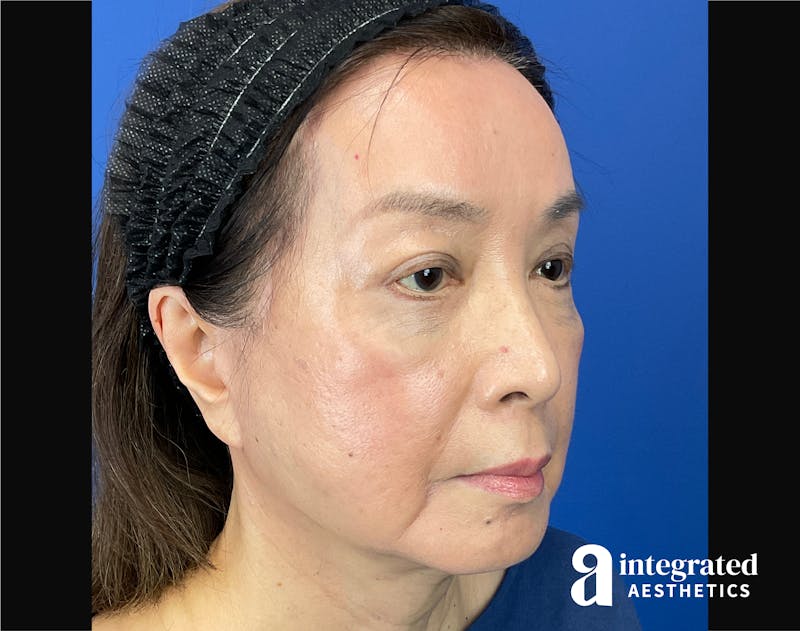 Facelift & Neck Lift Before & After Gallery - Patient 423746 - Image 4