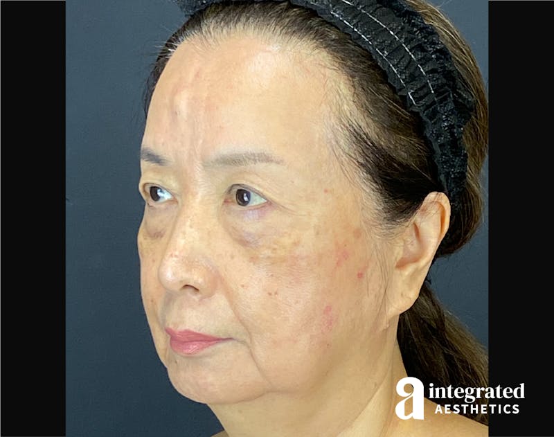 Facelift & Neck Lift Before & After Gallery - Patient 423746 - Image 5