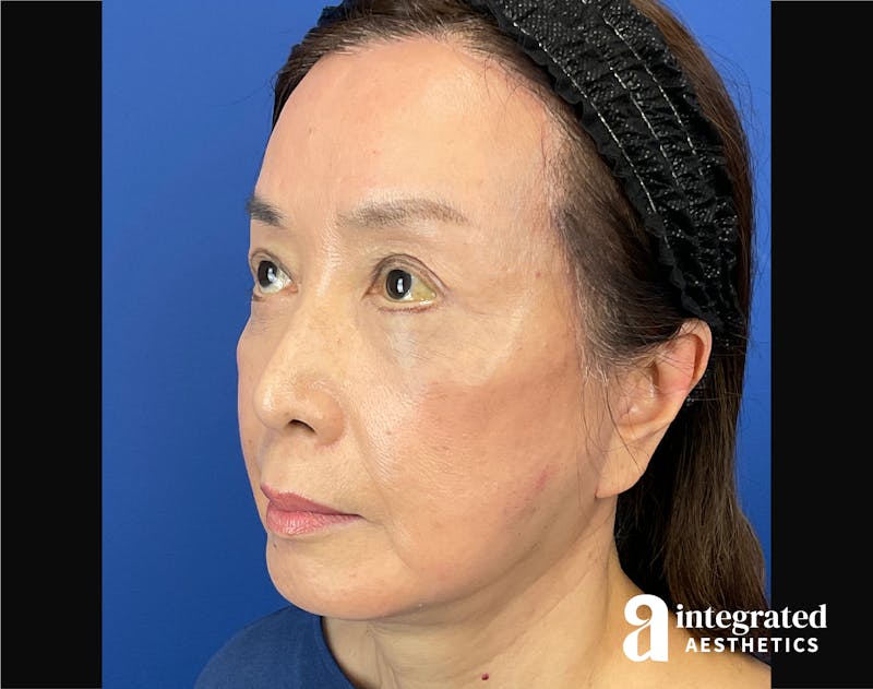 Facelift & Neck Lift Before & After Gallery - Patient 423746 - Image 6