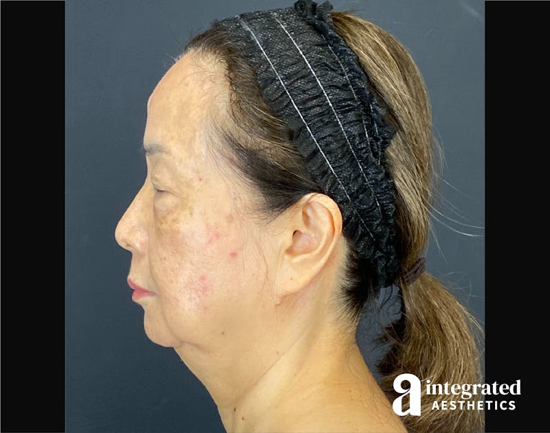 Facelift & Neck Lift Before & After Gallery - Patient 423746 - Image 7