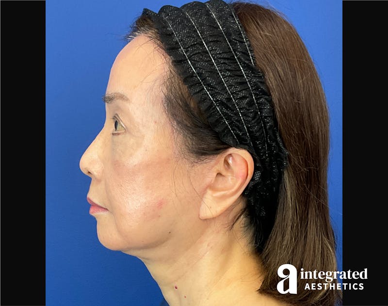 Facelift & Neck Lift Before & After Gallery - Patient 423746 - Image 8