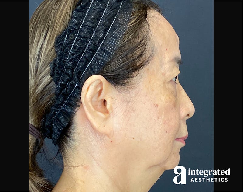 Facelift & Neck Lift Before & After Gallery - Patient 423746 - Image 9