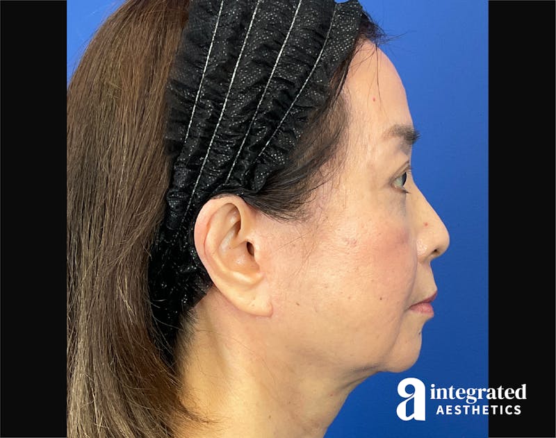 Facelift & Neck Lift Before & After Gallery - Patient 423746 - Image 10