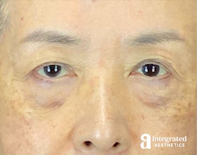Brow Lift Before & After Gallery - Patient 354679 - Image 1