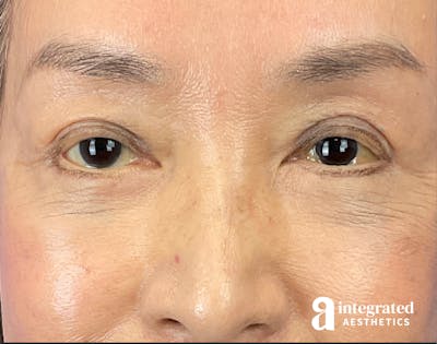 Brow Lift Before & After Gallery - Patient 354679 - Image 2