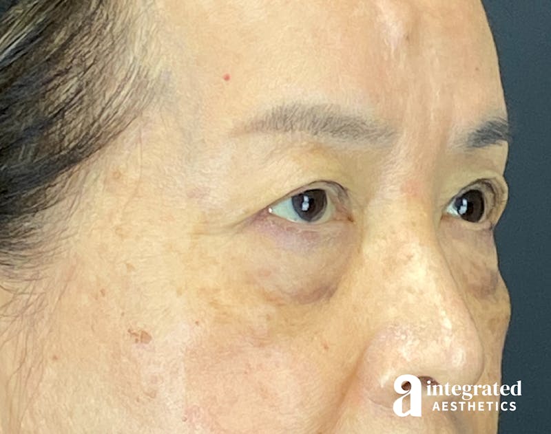Brow Lift Before & After Gallery - Patient 354679 - Image 3